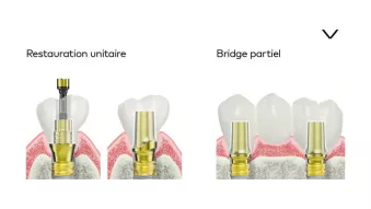 Prothèses d’usage