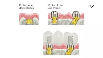 Phase de cicatrisation et temporisation immédiate