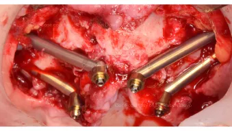 NobelZygoma TiUltra implants in place