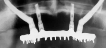 Presence of bone in zone I only, allows for treatment using the Zygoma concept.