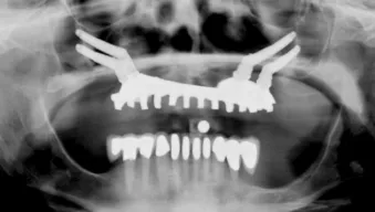 Insufficient bone in all three zones, allows for treatment using the Quad-zygoma concept.