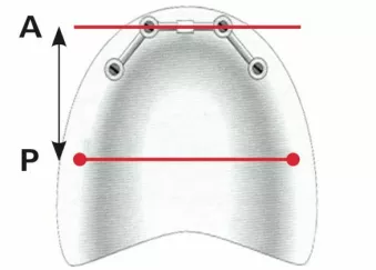 Anterior-Posterior distribution of the implants is limited by the maxillary sinus.