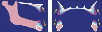 Depiction of the vertical, lingual and posterior resorption pattern of the maxilla.