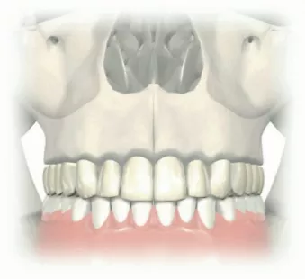 No alveolar atrophy — the cervical portion of the denture teeth is adjacent to the gingival crest.