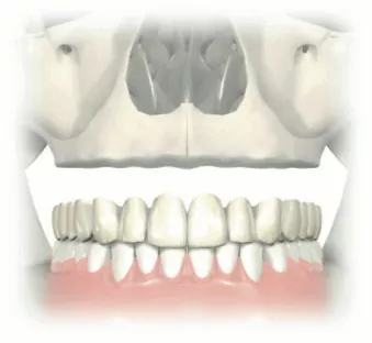 Composite defect — note the space between the crest of the denture teeth and the gingival crest.
