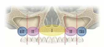 Zones of the maxilla. (See article for the key to use and subsequent images for illustrations.).