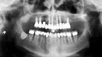 Presence of bone in all three zones allows for the axial placement of implants.