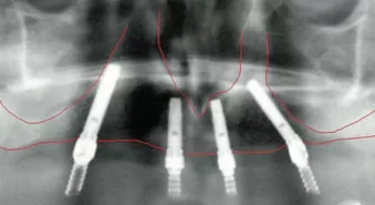 Presence of bone in zones I and II allows for treatment using the tilted implant concept.