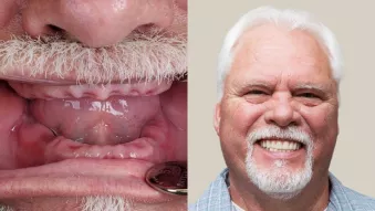 Completing Tim's smile with NobelProcera Zirconia Implant Bridge