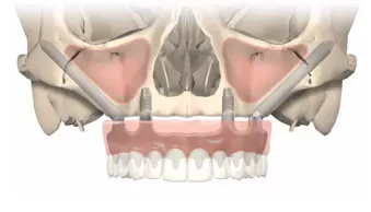 Zygomatic implants