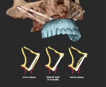 Nobel Biocare Zygoma implants