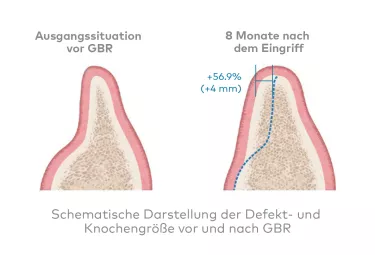 creos xenogain - Solide Grundlage für die Implantatinsertion