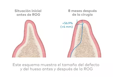 creos xenogain - Base sólida para la colocación de implantes