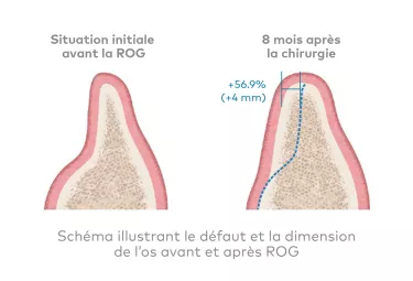 creos xenogain - Une base solide pour la pose d'implant