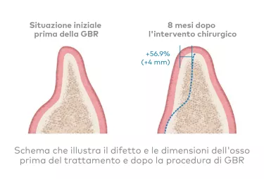 creos xenogain - Fondamenta solide per il posizionamento implantare