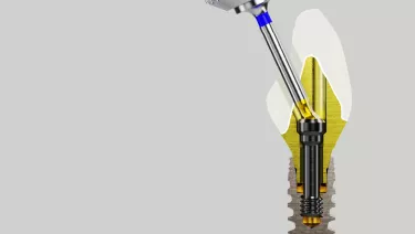 Angulated screw channel