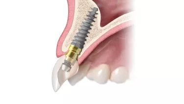 Angulated screw channel