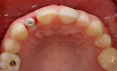 Cement retained above12 and screw retained below 16. Image courtesy of Dr.Stefan Holst
