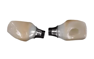 Customized abutments and implant crowns