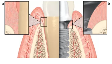 Comparison of periodontium and peri-implant soft tissue characteristics