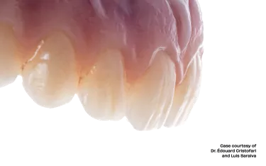 Zirconia implant bridge
