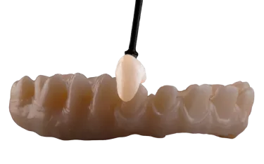 Procera crowns and bridges