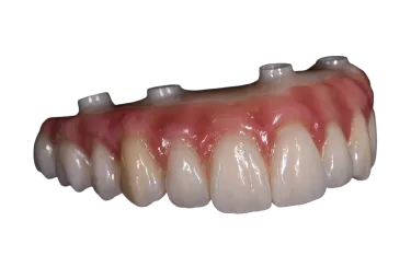 Procera implant bridges
