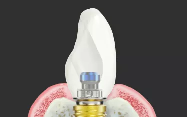 Procera innovation