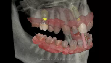 Single tooth