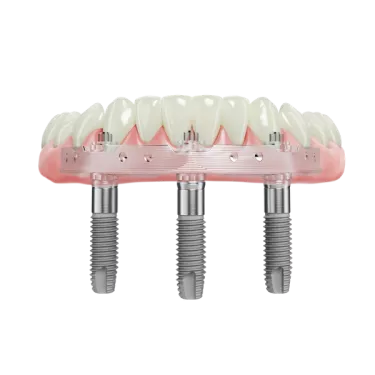 Trefoil system with denture