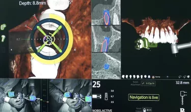 X-Guide provides a 360-degree, real-time view of the drill and anatomy.