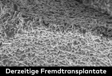 Derzeitige Fremdtransplantate