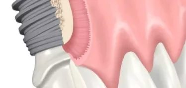 Crestal bone preservation and platform switching