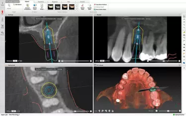 DTX Studio Implant