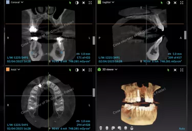 Case courtesy of Dr. Giacomo Fabbri