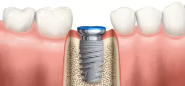 Implant position