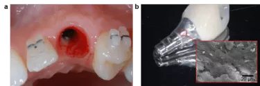 Disconnecting the healing abutment can rupture the adherent epithelial and connective tissue from underlying tissue.