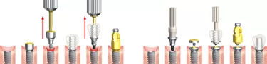 Comparison of a traditional prosthodontic procedure (left) with the On1 concept (right)