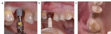 The On1 concept leaves the soft tissue undisturbed from implant placement onward.