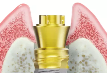 Nobel Biocare N1 Base