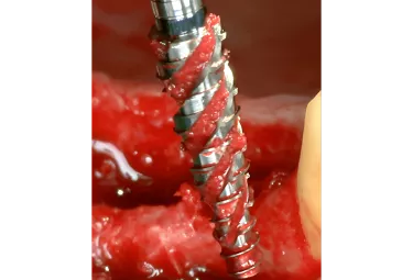 OsseoShaper