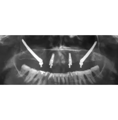 Orthopantomogram after placing the straight and angulated Multi-unit Abutments.
