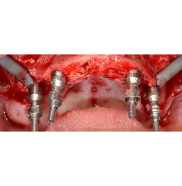 Preparation for impression coping after implant insertion