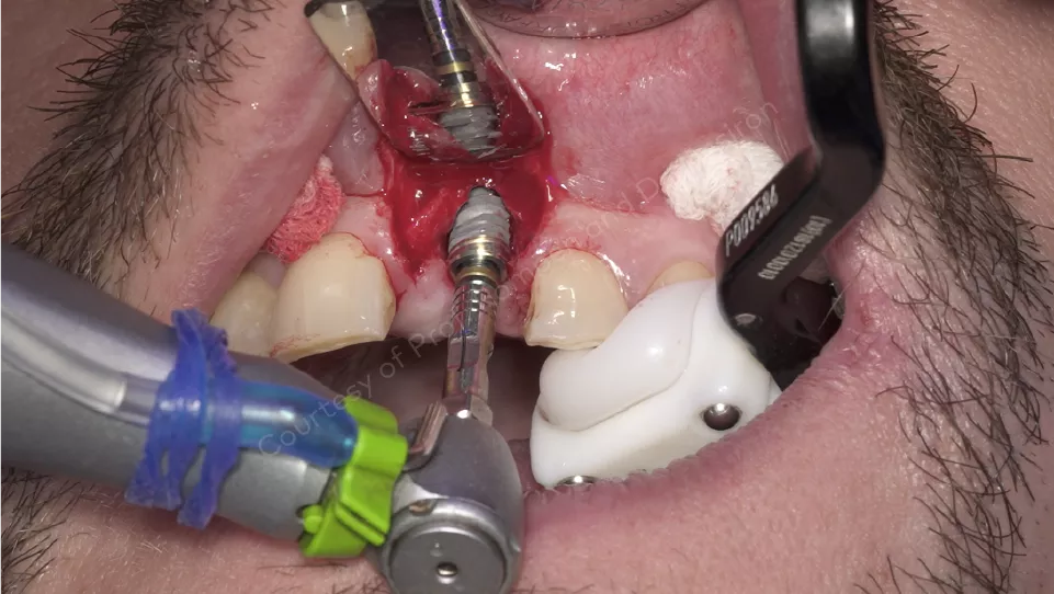 Case courtesy of Prof. Rompen and Dr. Désiron