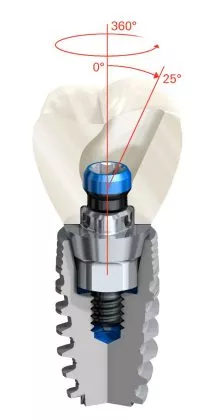 Full-contour zirconia (FCZ) Implant Crown