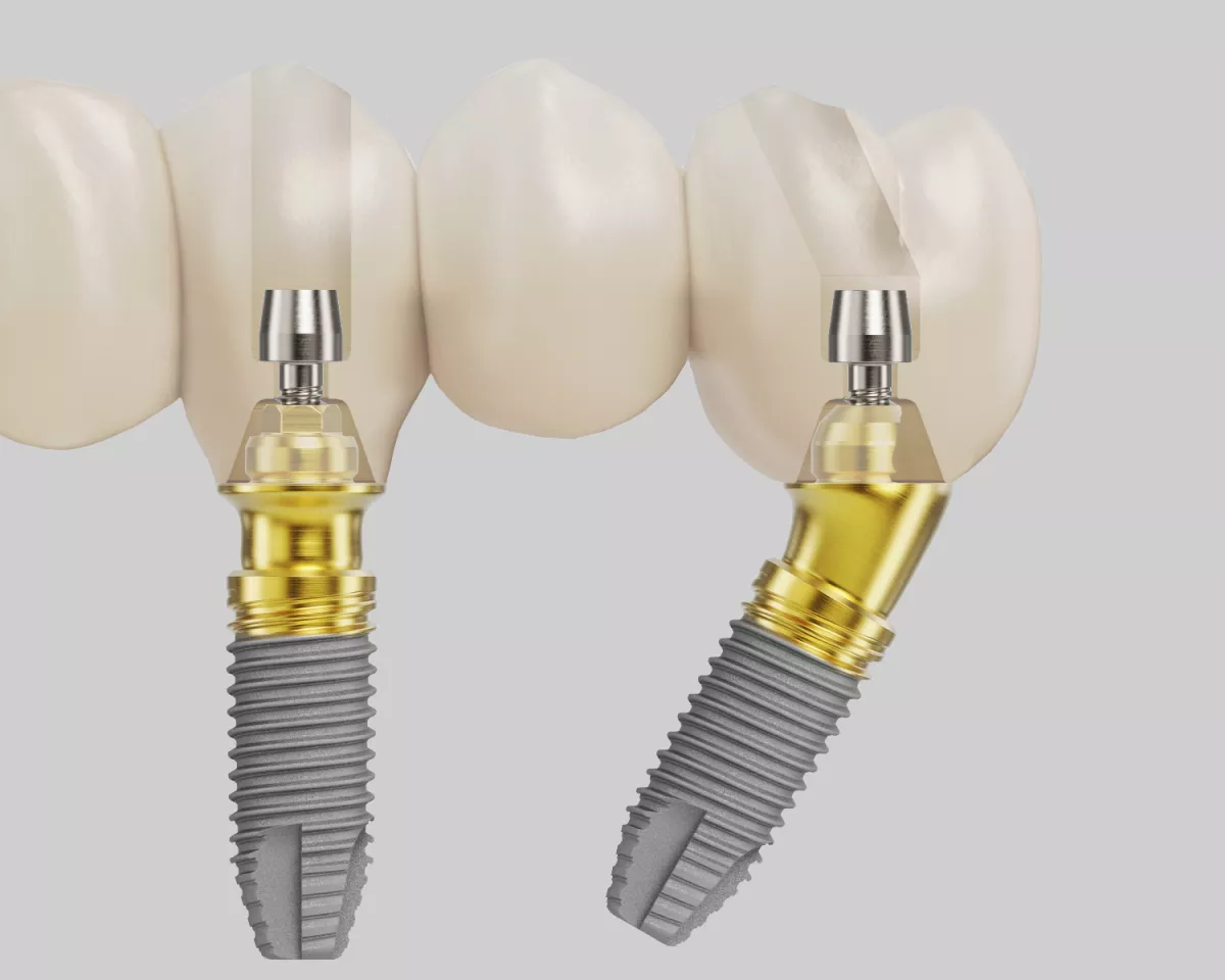 Temporary screw