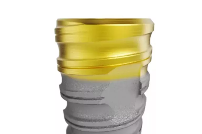 N1 System Implant