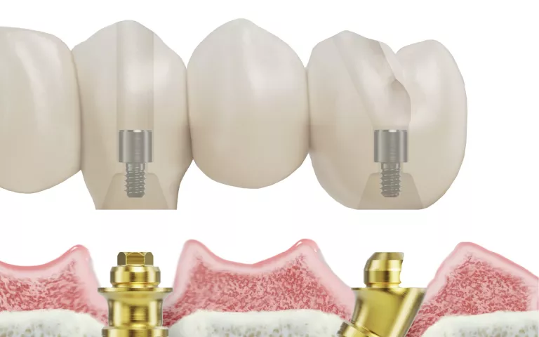 Cement-free restoration