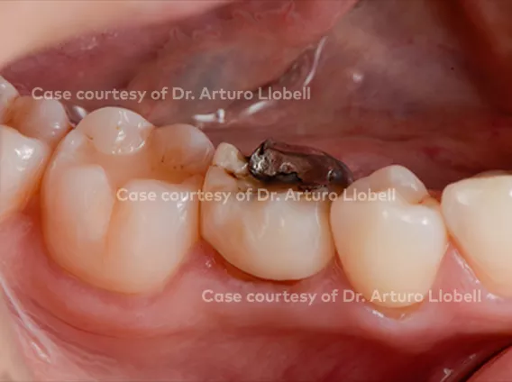 Immediate implant placement and provisionalization in a posterior site with the Nobel Biocare N1™ system