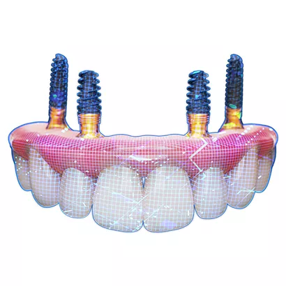All-on-4® digital workflow for full-arch rehabilitation